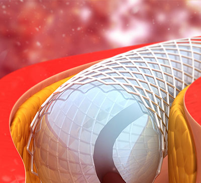 Drug Eluting Balloons Market by Product and Geography - Forecast and Analysis 2021-2025